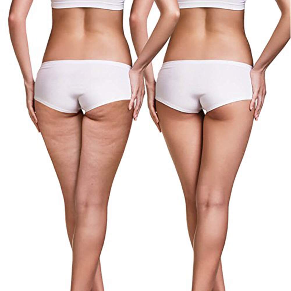 Innovation Sculptural Anti-Cellulite Massager for Body Wellness Smoothes the Skin